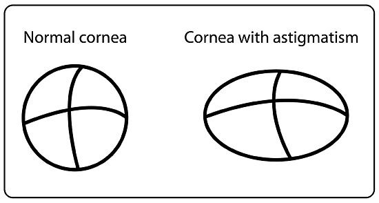 Laser αστιγματισμού