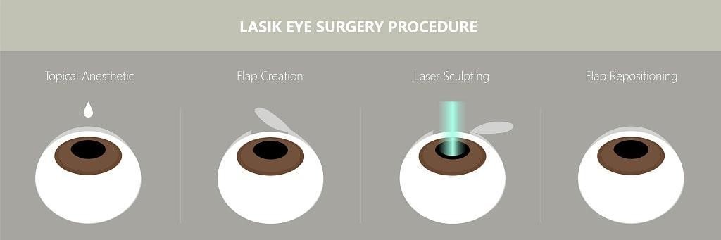 Επέμβαση LASIK