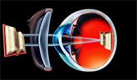 Laser υπερμετρωπίας