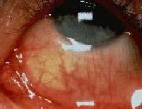 Αλλεργική επιπεφυκίτιδα μάτι