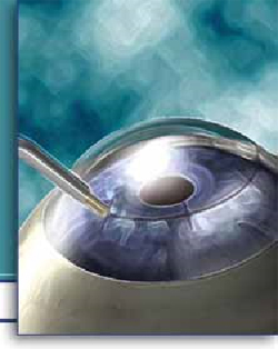 CK – Conductive Keratoplasty 1