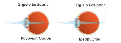 Laser πρεσβυωπίας lasereyes